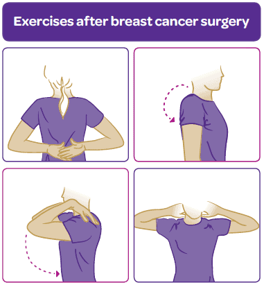 ασκησεις φυσικοθεραπειας μετα  τον καρκινο του μαστου