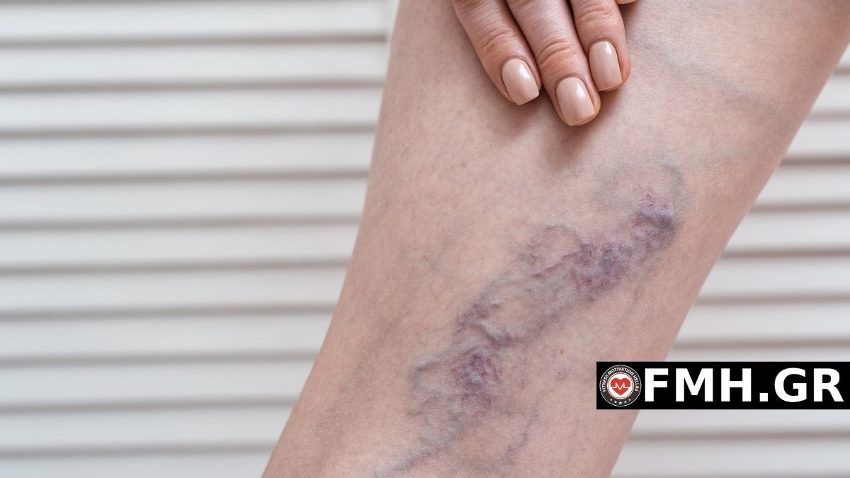 Θρόμβωση στο χέρι και στο πόδι: Συμπτώματα και Αντιμετώπιση