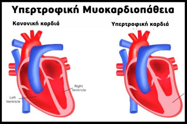 διαφορα κανονικης καρδιας με υπερτροφικη καρδια 