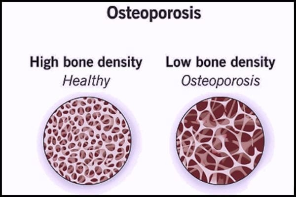 μπορεί να πάθουν κάταγμα εξαιτίας της οστεοπόρωσης είναι ο καρπός και το ισχίο